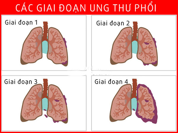 Các giai đoạn của ung thư phổi