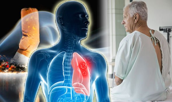 Thời gian sống của bệnh nhân ung thư phổi giai đoạn 4 là rất ngắn