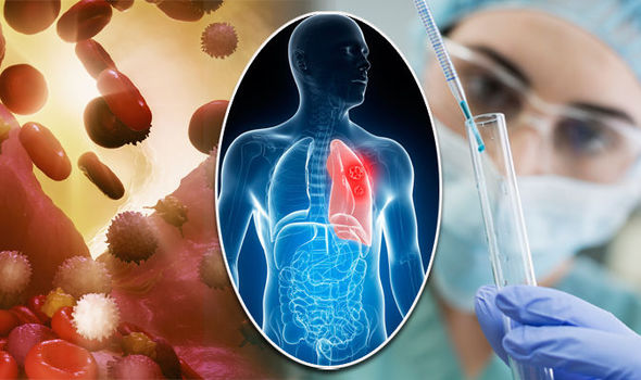 Ung thư phổi là căn bệnh về đường hô hấp ngày càng phổ biến Ung thư phổi là căn bệnh về đường hô hấp ngày càng phổ biến