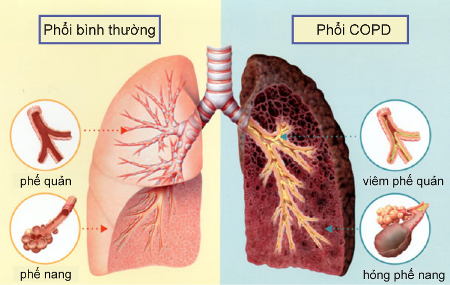 Ung thư phổi di căn là tình trạng các tế bào ung thư lây lan khắp cơ thể