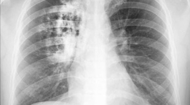 Kết hợp nhiều phương pháp để điều trị bệnh ung thư phổi